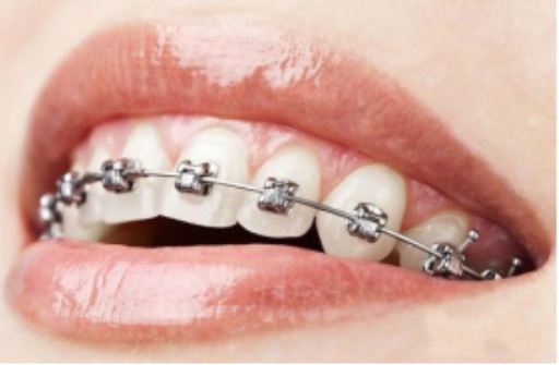 声波树脂补牙的优点（声波树脂和复合树脂的区别）
